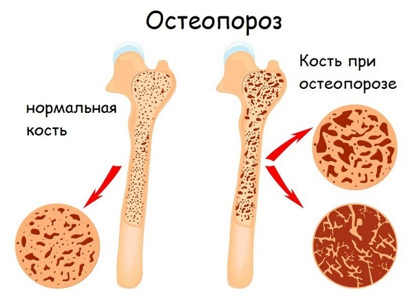 Денситометрия основной способ борьбы с остеопорозом | Статьи
