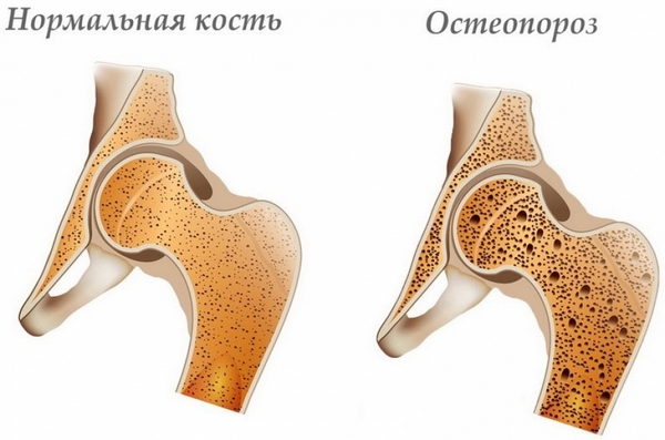 диагностика остеопороза денситометрия