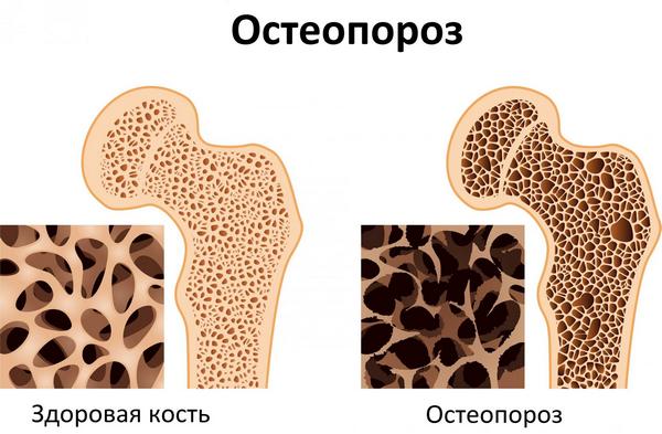 Денситометрия остеопороза