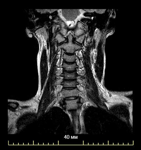 Мрт шейного отдела позвоночника по времени. Мрт шейного отдела позвоночника. Мрт шейного отдела позвоночника и сосудов. Шейный отдел позвоночника артерии шеи мрт. Мрт шейно воротниковой зоны.