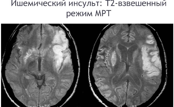 мрт головного мозга
