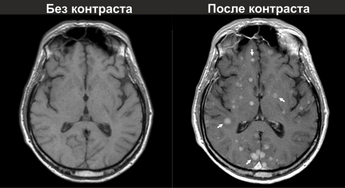 кт головного мозга с контрастом и без контраста