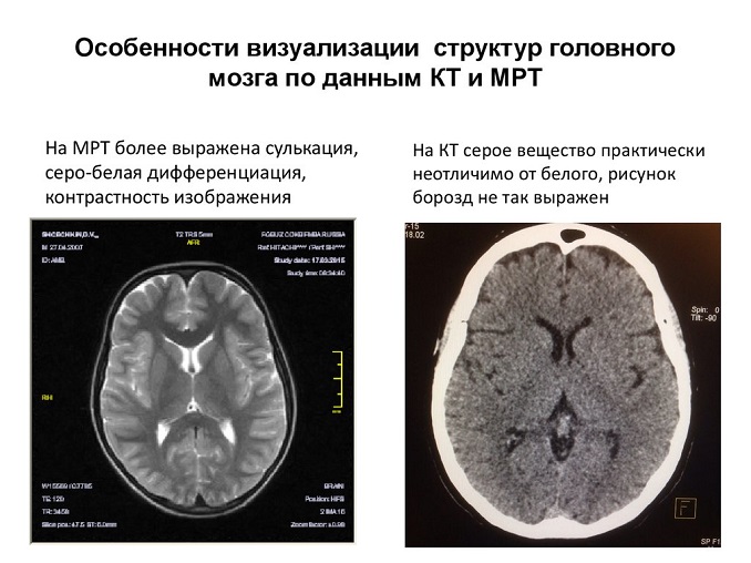 различия кт и мрт на примере головного мозга