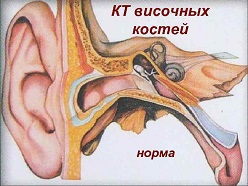 томография уха