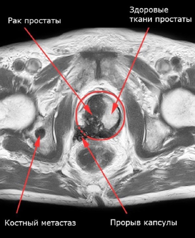 Простата минск. Опухоли предстательной железы мрт. Кт малого таза предстательная железа. Гипертрофия предстательной железы кт. Магнитно-резонансная томографии (мрт) предстательной железы.