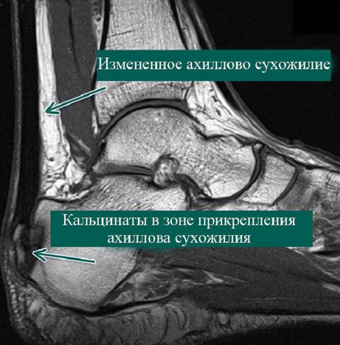 томография сухожилий