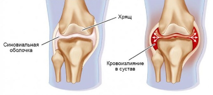 синовиальная складка