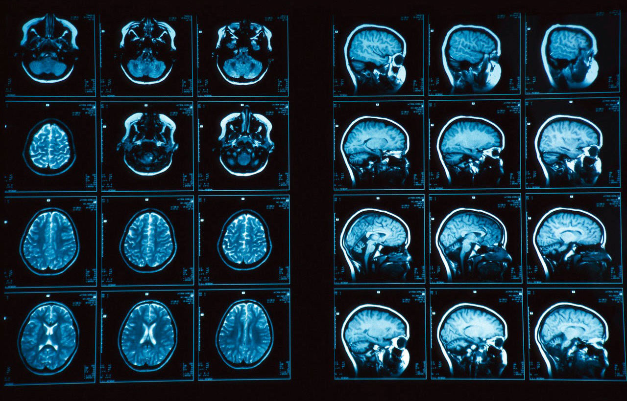 Как проводят мрт головного мозга