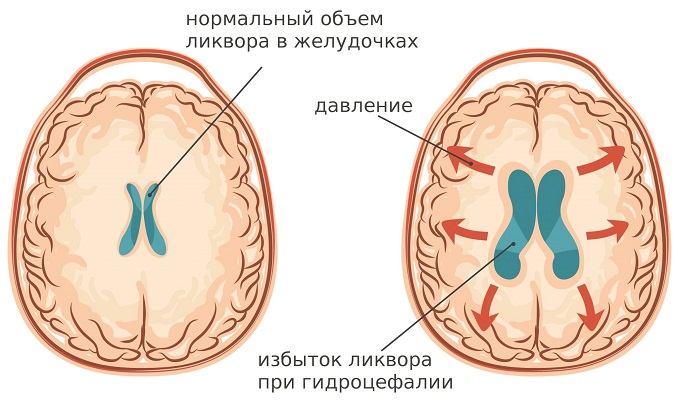 Особенности и механизм развития гидроцефалии