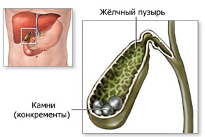 Камни В Желчном Пузыре Фото