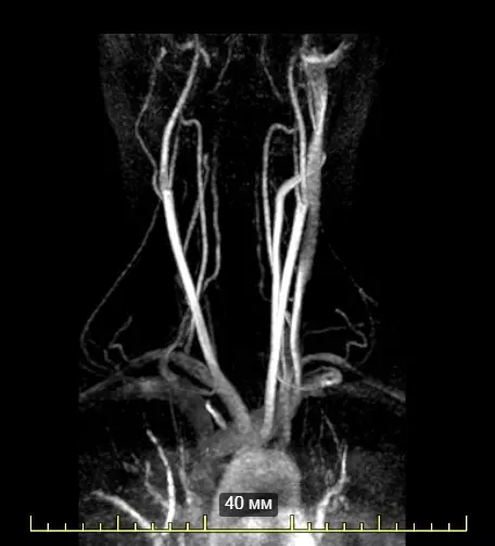 Позвоночные артерии. Синдром позвоночной артерии: симптомы, диагностика, лечение