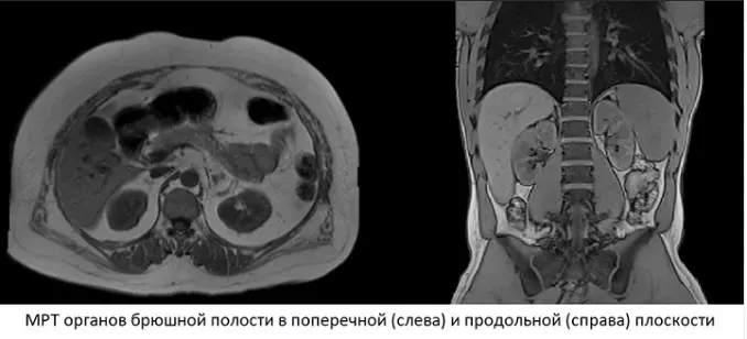 Магнитно-резонансная томография кишечника: подробный обзор