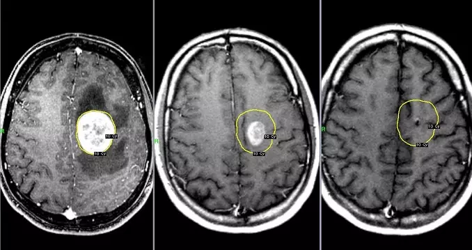 Что показывает МРТ мозга, для чего проводится процедура, особенности  процедуры МРТ головного мозга